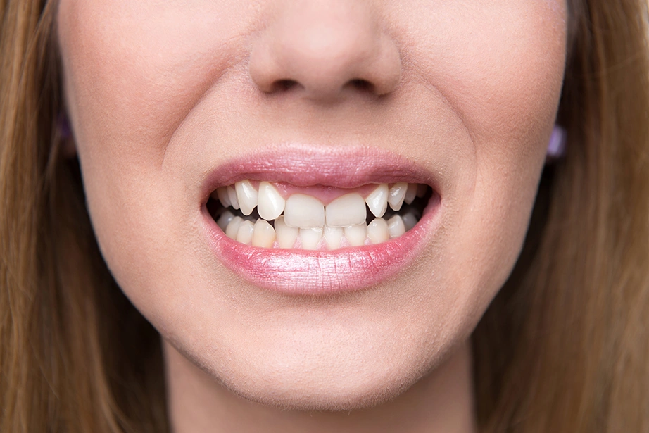 Mulher com dentes tortos.