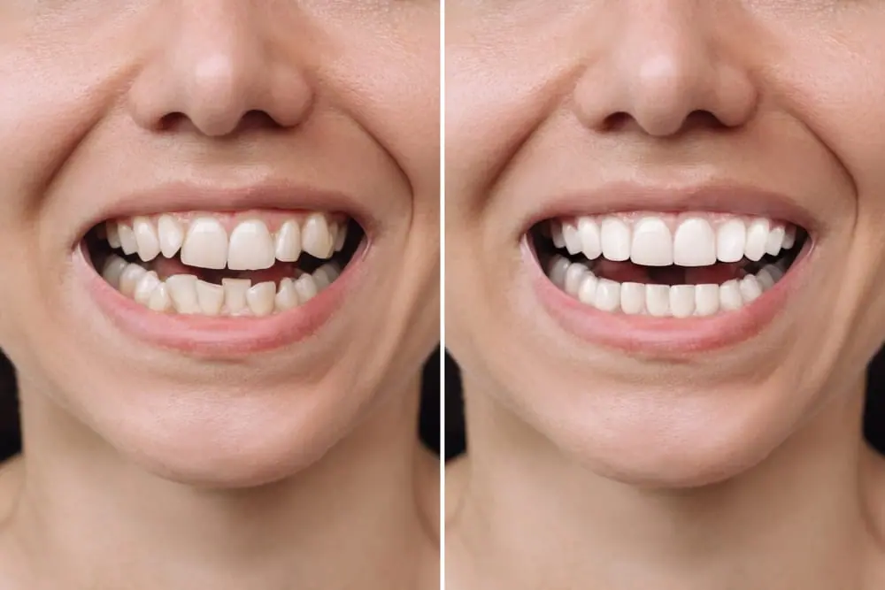 Antes e depois de tratar oclusões nos dentes.
