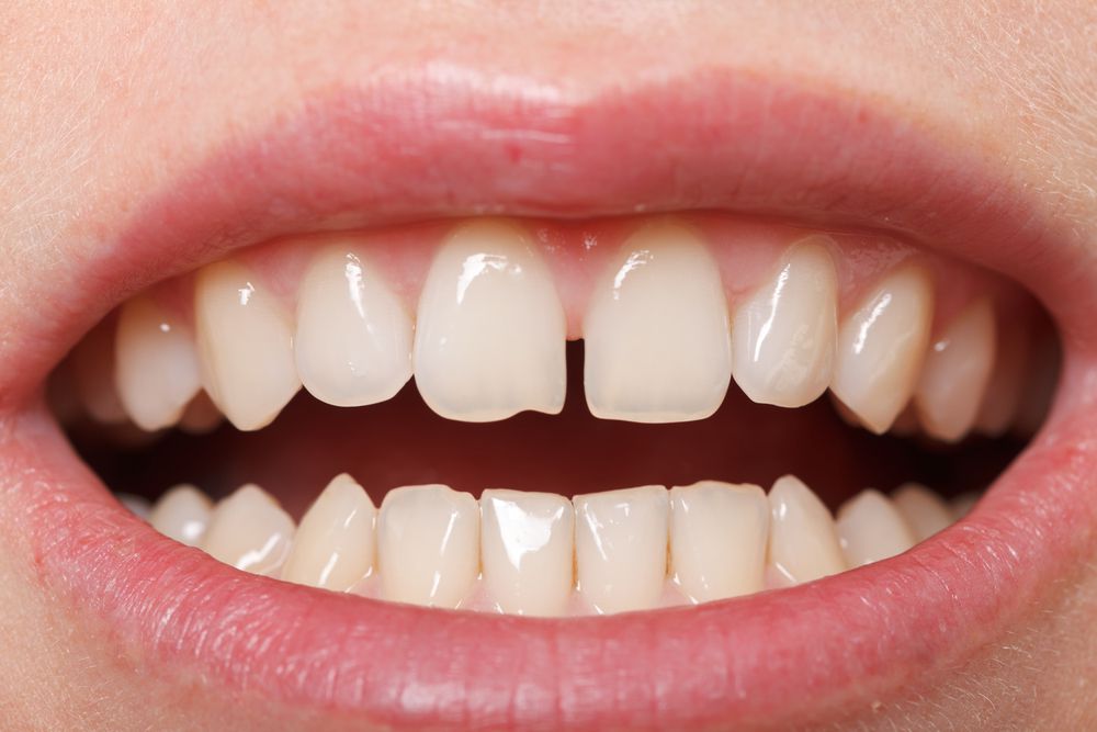 Pessoa com diastema
